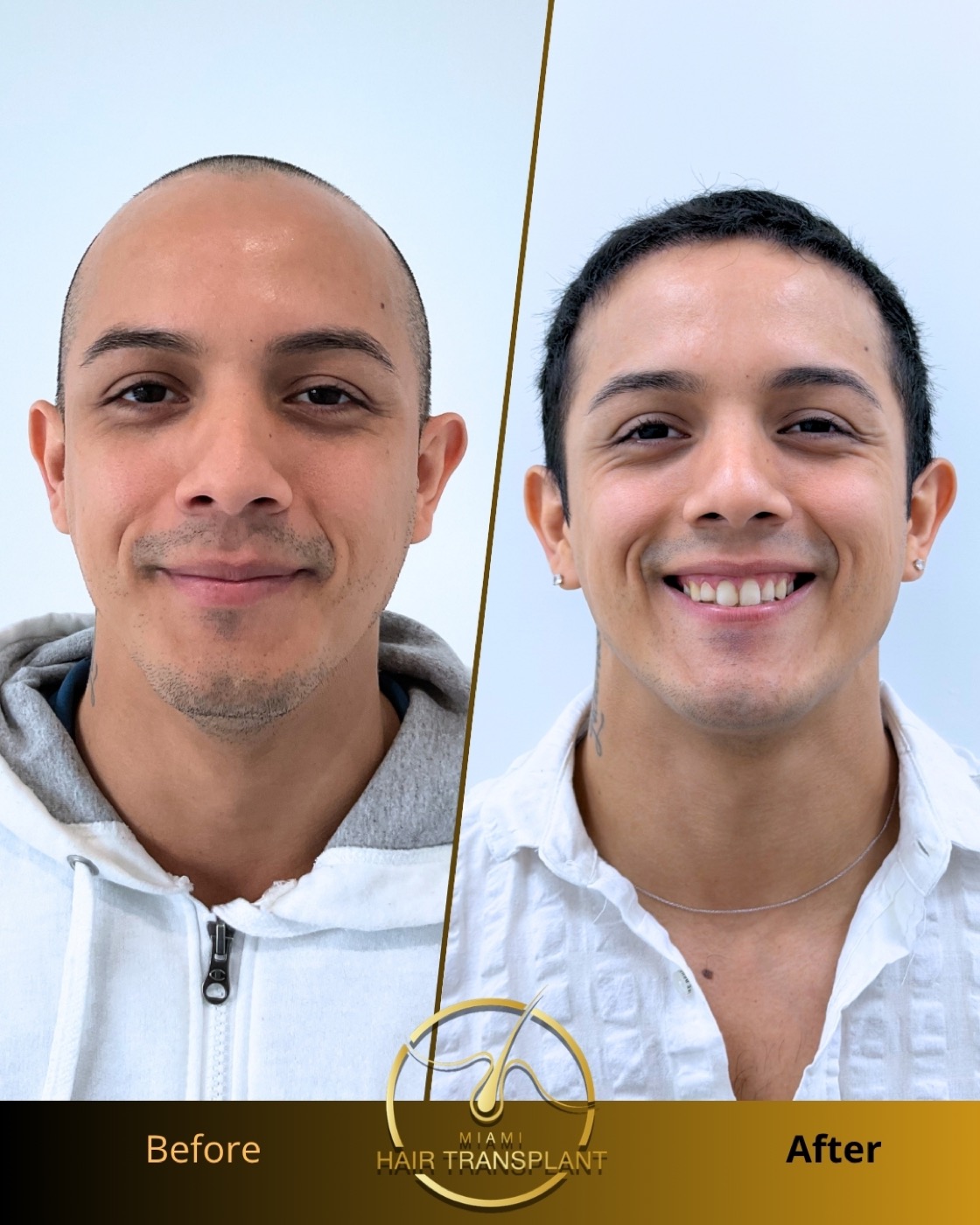 Before and after: FUE hair transplant, five months post-op