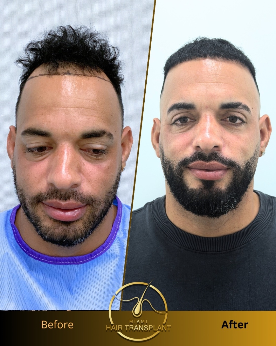 Before and after: Sapphire FUE hair transplant, nine months post-op