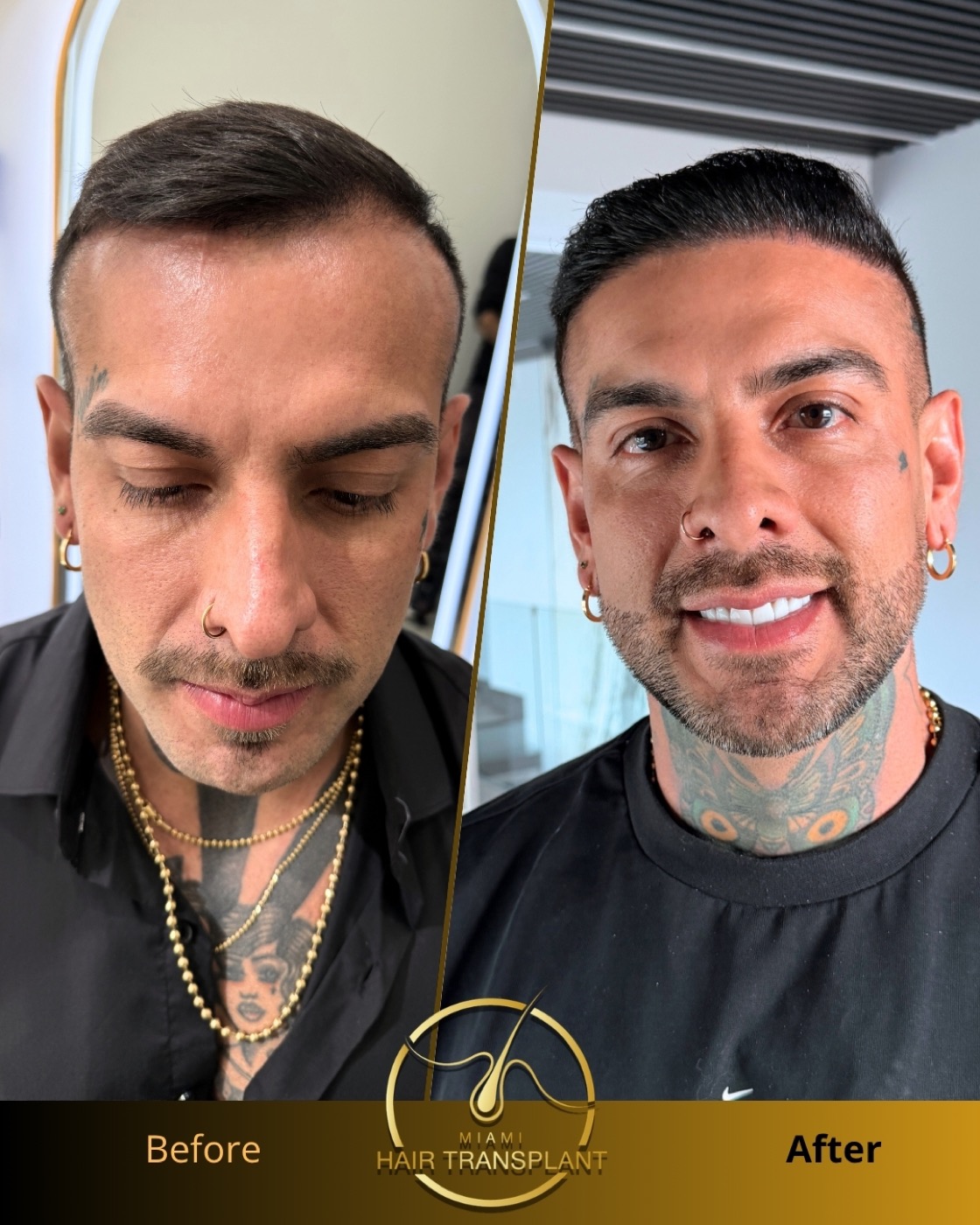 Before and after: mid-scalp and crown FUE restoration, ten months post-op