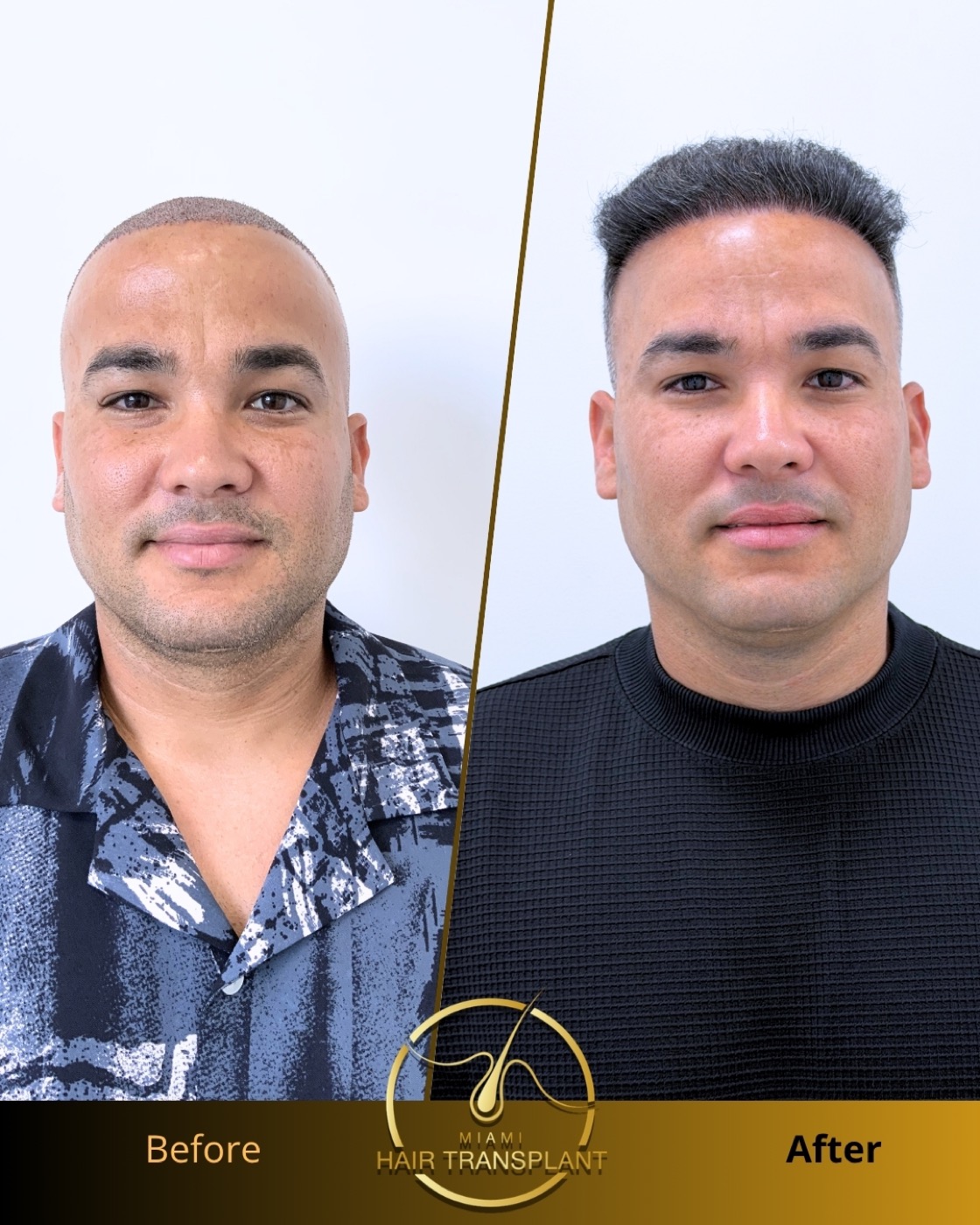 Before and after: crown-focused FUE restoration, eight months post-op